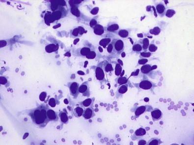 Figure 18-10, Epithelioid leiomyosarcoma. FNAB of epithelioid leiomyosarcoma demonstrating polygonal shapes, poor cohesion, and generous cytoplasm (May–Grünwald–Giemsa, ×HP).