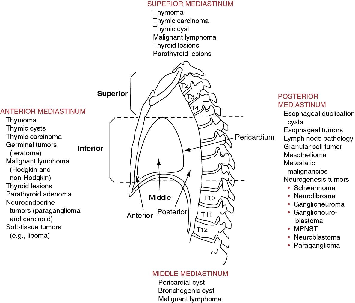 • Fig. 20.1, Common lesions of the mediastinum. MPNST , malignant peripheral nerve sheath tumor.