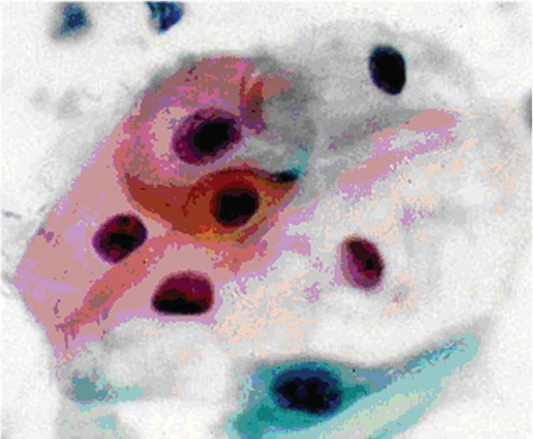 • Fig. 20.2, Sample from the esophageal squamous mucosa showing polygonal cells with abundant hard cytoplasm with hyperchromatic nuclei. Squamous cells also show maturation, as evidenced by keratinization.