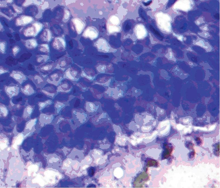 • Fig. 20.3, Smears from the gastric mucosa reveal foveolar cells with cohesive cell groups with minimal overlapping. The cells show a columnar shape with nuclei lined at the base. They also show a round, regular nuclear membrane and inconspicuous nucleoli, if any (Diff-Quik stain; magnification ×20).