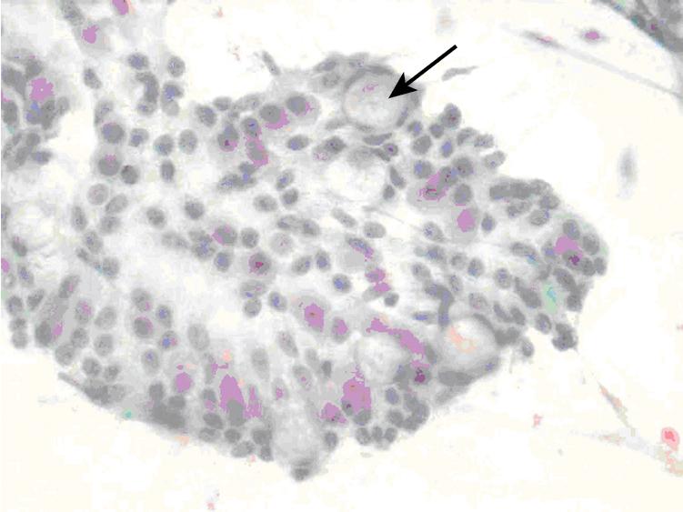 • Fig. 20.4, Smear reveals a cohesive two-dimensional group of epithelial cells with a honeycomb appearance. The group also reveals interspersed goblet cells (arrow) consistent with surface duodenal mucosal cells (Papanicolaou stain; magnification ×40).