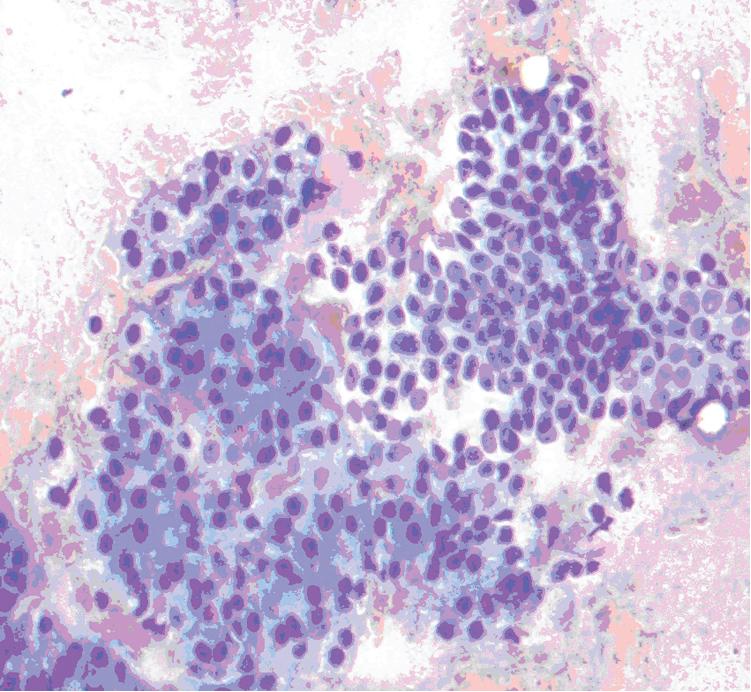 • Fig. 20.5, Smear from EUS fine-needle aspiration of pancreas reveals many acini and ductal cells. Acinar cells show moderate granular and two-toned amphophilic cytoplasm. The nuclei are centrally placed with a round, regular nuclear membrane. In comparison, the smear also reveals ductal epithelial cells. These cells show a cohesive two-dimensional honeycomb group of ductal epithelial cells. These cells reveal clear, well-demarcated cytoplasm (Diff-Quik stain; magnification ×20).