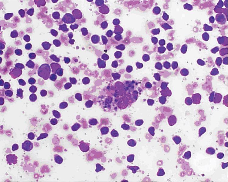 • Fig. 20.6, EUS fine-needle aspiration from a reactive mediastinal lymph node reveals many lymphocytes of varying sizes. Tingible body macrophages are also noted (Diff-Quik stain; magnification ×20).