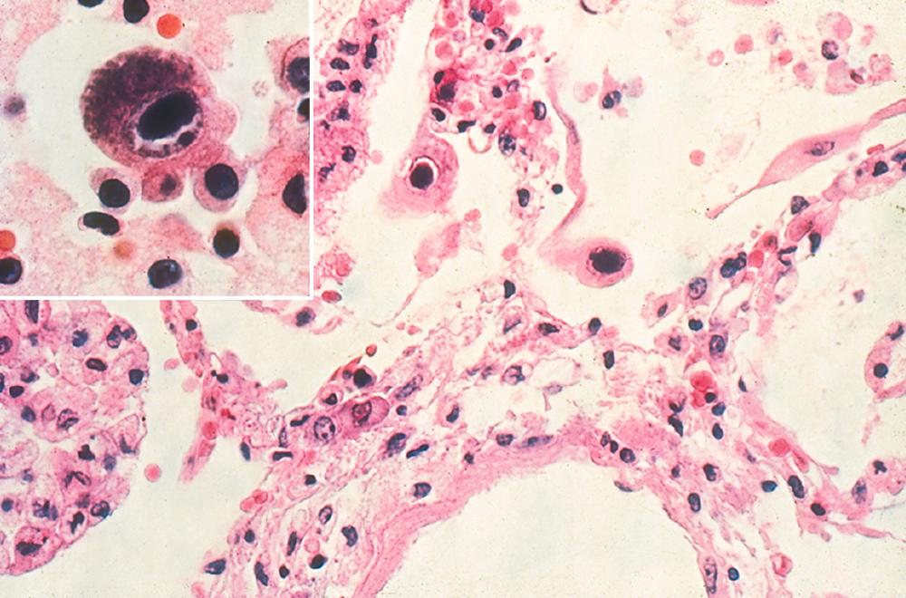 FIGURE 347-1, Cytomegalovirus (CMV) pneumonia.