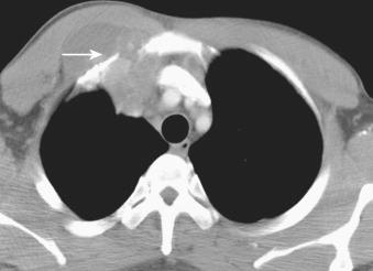 Figure 4.1, Computed tomogram of the chest. A large, partially necrotic mass (arrow) involves the right lung, mediastinum, and thoracic soft tissue, with destruction of the rib.