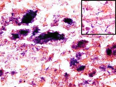 Figure 4.11, Fine-needle aspiration of cervical actinomycosis. Clumps of gram-positive bacilli are seen (Gram-Weigert stain, ×400), with branching form seen in inset (Gram-Weigert stain, ×1000).