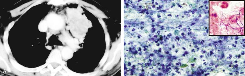 Figure 4.12, Pulmonary nocardiosis in a heart transplant recipient. A, Chest computed tomography (CT) shows large left upper lobe infiltrate with areas of necrosis. B, CT-guided fine-needle aspiration of infiltrate demonstrates the presence of a necrotizing, fibrinopurulent inflammation (Papanicolaou stain, ×400). In the inset , branching gram-positive filamentous bacilli are revealed by a Gram stain (Gram-Weigert stain, ×1000).