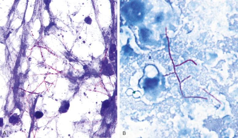 Figure 4.13, Nocardia sp. (A) and MFC (B) in modified acid-fast stains. A, Branching, beaded filaments. B, In this image, MFC appears slightly thicker and has shorter branches than Nocardia ; however, these features are not adequate for definitive distinction from Nocardia spp. (Kinyoun stain, ×2000).