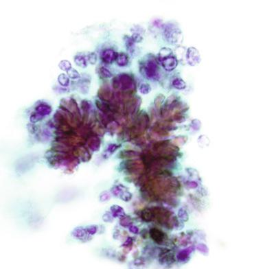 Figure 4.14, Cervical liquid-based Papanicolaou test from a pregnant woman with pseudoactinomycotic radiating granules. Note the similarity to actinomycotic Splendore-Hoeppli phenomenon. However, no bacterial filaments are present (Papanicolaou stain, ×1600).