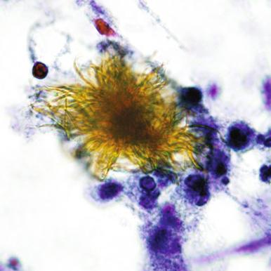 Figure 4.15, Fine-needle aspiration of a subcutaneous fistula derived from pancreatic pseudocyst. A cockleburr-like, golden-yellow crystal typical of hematoidin is seen (Papanicolaou stain, ×1600).