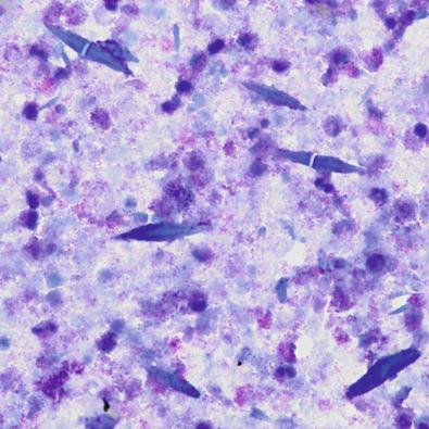 Figure 4.16, Fine-needle aspiration of a hepatic eosinophilic pseudotumor. Abundant degenerating eosinophils, extracellular eosinophilic granules, and blue-colored Charcot-Leyden crystals are seen (Romanowsky stain, ×600).