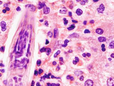 Figure 4.17, Excisional biopsy of liver mass in a case of visceral larva migrans. Abundant eosinophils are seen surrounding a portion of nematode larva. Dotlike internal structures are often seen in cytologic and histologic preparations of nematodes (hematoxylin and eosin stain, ×1000).