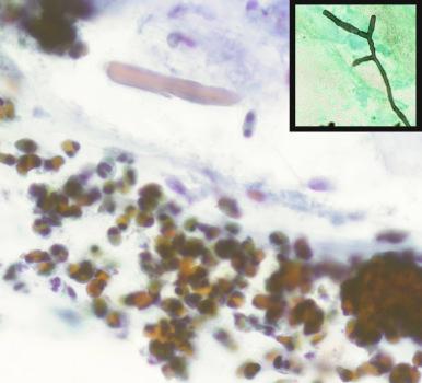 Figure 4.18, Fungal mucus plug in a bronchial brushing slide. Within strands of pale blue-colored mucin, there are sheets of eosinophils in the lower half of the image and a Charcot-Leyden crystal in the upper center (Papanicolaou stain, ×400). In the inset, branching hyphae are seen in silver-stained preparation (Grocott-Gomori methenamine silver stain, ×400).