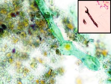 Figure 4.20, Aspiration of ethmoid sinus from another case of allergic fungal sinusitis. There are necrotic eosinophils and a strand of cyanophilic fungal hyphae (Papanicolaou stain, ×1600). The fungi did not appear brown on Papanicolaou stain; however, they were shown to be dematiaceous by melanin stain of surgical curettage ( inset: Fontana-Masson stain, ×400).