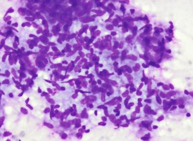 Figure 4.2, Fine-needle aspiration of right chest wall mass from the same patient as in Fig. 4.1 . An aggregate of epithelioid macrophages admixed with lymphocytes is seen. Caseation (also present, focally) is not illustrated in this image (Romanowsky stain, ×400).