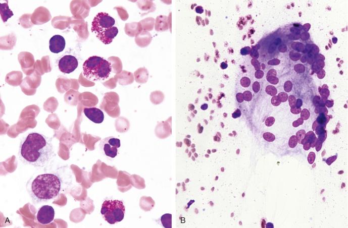 Figure 4.21, Fine-needle aspiration of inguinal lymph node from a case of disseminated coccidioidomycosis with marked peripheral blood eosinophilia. A, Mixed inflammatory cell reaction with presence of eosinophils (Romanowsky stain, ×1000). B, Giant cell macrophage (Romanowsky stain, ×400).