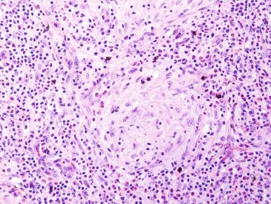 Figure 4.22, Lymph node biopsy specimen from the same patient as in Fig. 4.21 . Well-formed granulomas are surrounded by an eosinophil-rich inflammatory exudate (hematoxylin and eosin stain, ×200).