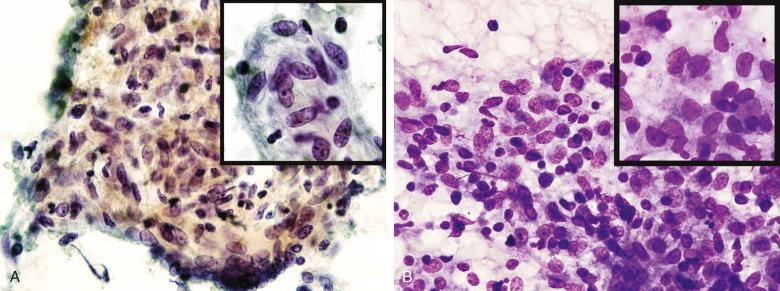 Figure 4.23, Fine-needle aspiration of lymph nodes that had noncaseating granulomas. A, Cervical lymph node from a patient with sarcoidosis shows aggregates of epithelioid macrophages with elongated to boomerang-shaped nuclei and poorly defined cytoplasmic borders (Papanicolaou stain, ×400; inset ×1000). B, Cervical lymph node from a woman with tuberculosis shows similar features (Romanowsky stain, ×400; inset ×1000).