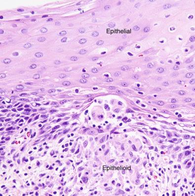 Figure 4.24, Tonsil biopsy from a patient with sarcoidosis. Note the squamous epithelium above and the aggregates of epithelioid macrophages below (hematoxylin and eosin stain, ×400).