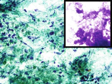 Figure 4.25, Fine-needle aspiration from caseating granuloma. Amorphous granular, green material is admixed with few cell nuclei (Papanicolaou stain, ×400). The material appears less granular and equally amorphous in Romanowsky stain ( inset: Romanowsky stain, ×400).