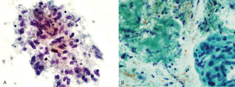 Figure 4.26, Caseating granulomata diagnosed by bronchial brushings. A, A loosely formed aggregate of epithelioid macrophages admixed with amorphous granular material is seen (Papanicolaou stain, ×400). B, Amorphous granular material with entrapped nuclei is seen on the left, and reactive squamous metaplasia on the right. The latter can result in misdiagnosis of neoplasia (Papanicolaou stain, ×400).