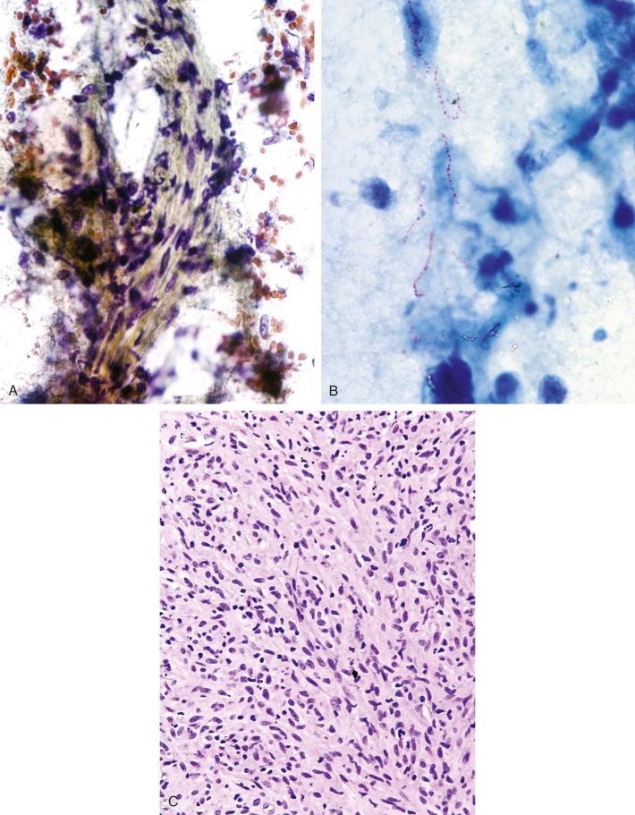 Figure 4.28, Mycobacterium kansasii spindle-cell granuloma in an acquired immune deficiency syndrome patient. A, Transbronchial fine-needle aspiration (FNA) shows a group of spindly cells (Papanicolaou stain, ×600). B, Long, coarsely beaded bacilli are seen in an acid-fast stain of the FNA sample (Kinyoun stain, ×1600). C, Transbronchial biopsy from the same patient (hematoxylin and eosin stain, ×600).