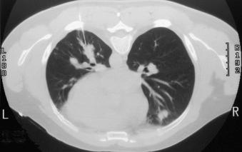 Figure 4.29, Chest computed tomogram showing multiple, bilateral pulmonary opacities, one of which was sampled by percutaneous fine-needle aspiration (see Fig. 4.30 ).