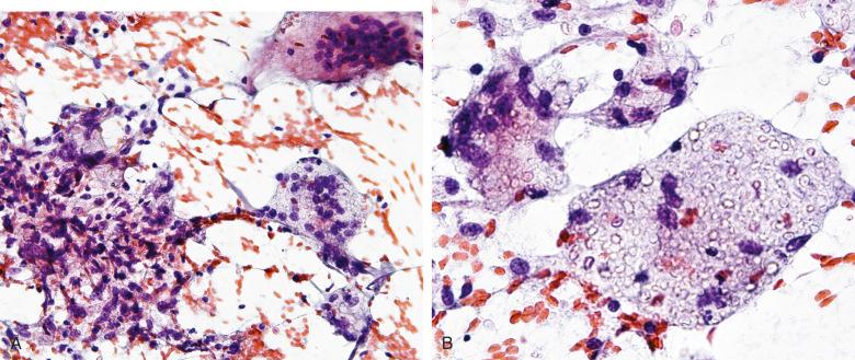 Figure 4.30, Fine-needle aspiration of the pulmonary lesions illustrated in Fig. 4.29 . A, An aggregation of macrophages and several multinucleated giant cells are seen (Papanicolaou stain, ×200). B, Multinucleated cells contain refractile, round yeast forms (Papanicolaou stain, ×400).