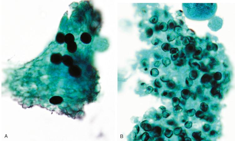 Figure 4.3, Bronchoalveolar lavage samples with Pneumocystis . A, Sample is overstained. The cysts appear dense and homogeneously black. B, Properly stained sample demonstrates the presence of a small, dotlike thickening in the cyst wall (Grocott-Gomori methenamine silver stain, ×1000).