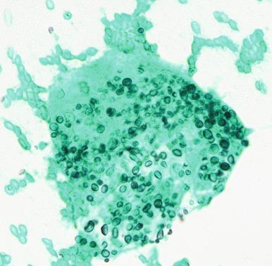 Figure 4.31, Grocott-Gomori methenamine silver (GMS)-stained slide from the same patient as in Figs. 4.29 and 4.30 , showing round shape and variability in size of yeast forms (GMS stain, ×400).