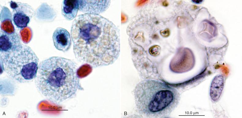 Figure 4.32, Comparison of lipid- and erythrocyte-laden macrophages to Cryptococcus . A, Intraoperative aspiration of a Rathke cleft cyst of the brain. Macrophages containing lipidlike vacuoles and degenerating erythrocytes are seen (Papanicolaou stain, ×2000). B, Bronchoalveolar lavage specimen containing macrophages with phagocytized Cryptococcus neoformans . Note marked variation in size of yeast forms and the presence of refractile granular material within some yeast (Papanicolaou stain, ×2000).