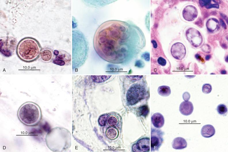 Figure 4.33, Comparison of Blastomyces dermatitidis, Coccidioides immitis, Paracoccidioides brasiliensis, and Cryptococcus neoformans . A, B. dermatitidis . The yeast form is approximately 12 µm in diameter, with a broad-based bud and a thick, refractile cell wall. A narrow clear zone separates the fungal protoplasm from the cell wall. B, Mature spherule of C. immitis . The spherule has a round shape, is relatively large, has a thick cell wall, and contains multiple round endospores. C, Yeast forms of P. brasiliensis lack the classic “ship's wheel” budding. Yeasts are more variable in size than Blastomyces but are easily confused with both Blastomyces and with immature forms of Coccidioides . D, Nonbudding form of Blastomyces . E, Closely apposed immature spherules of Coccidioides immitis imitating Blastomyces . F, Yeast forms of Cryptococcus neoformans ( A, B, and D-F, Papanicolaou stain, ×2000; C and E, hematoxylin and eosin stain, ×2000).