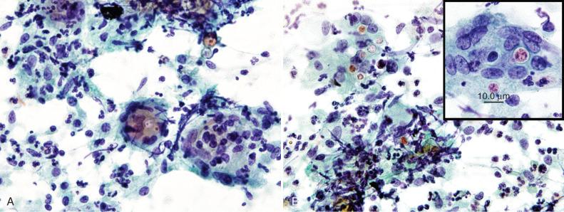 Figure 4.34, Bronchial brushing from a case of pulmonary blastomycosis. A, An inflammatory exudate composed of neutrophils, epithelioid cells, and giant cells is seen (Papanicolaou stain, ×400). B, Yeast like cells are seen within giant cell macrophages (Papanicolaou stain, ×400). Higher magnification of yeast forms is seen in the inset (Papanicolaou stain, ×1000).