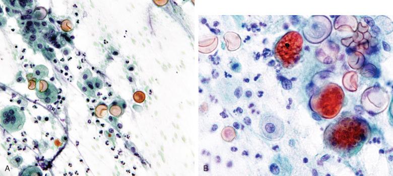Figure 4.35, Fine-needle aspiration of subcutaneous coccidioidomycosis. A, A mixture of neutrophils, epithelioid macrophages, and giant cells is seen, along with empty and collapsing spherules (Papanicolaou stain, ×200). B, Mature endosporulating spherules are seen, along with empty and collapsed forms (Papanicolaou stain, ×400).