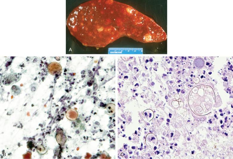 Figure 4.36, Disseminated coccidioidomycosis in a patient with AIDS. A, Gross photograph of spleen at autopsy. B, Postmortem scraping of one of the splenic lesions shows necrotic debris, scanty macrophages and neutrophils, and abundant spherules (Papanicolaou stain, ×400). C, Postmortem section of spleen shows the presence of abundant necrosis and spherules and relatively scanty inflammation (hematoxylin and eosin stain, ×400).