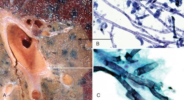 Figure 4.37, Invasive pulmonary aspergillosis in a severely neutropenic patient. A, Cross-section of lung taken at autopsy shows the presence of round, pale regions and vascular thromboses. B, Scraping of pale round area indicated by black arrow. Fibrin and fungal hyphae with narrow angle branching are seen (Papanicolaou stain, ×1000). C, Scraping of intravascular thrombus indicated by white arrow. Fungal hyphae are present (Grocott-Gomori methenamine silver stain, ×1500).