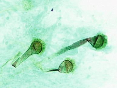 Figure 4.38, Bronchial brushing from endobronchial aspergillosis with formation of fruiting heads. Conidiophores contain the typical fruiting heads of Aspergillus fumigatus (Grocott-Gomori methenamine silver stain, ×1500).