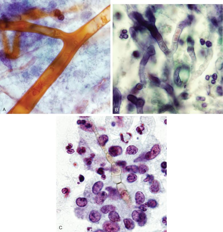 Figure 4.39, Comparison of fungal hyphae in Papanicolaou-stained preparations. A, Zygomycete ( Rhizopus sp. by culture) with easily seen broad hyphae. B, Culture-proven Aspergillus sp. showing more narrow hyphae. C, Dematiaceous fungus ( Phialophora verrucosa by culture) showing brown cell wall and moniliform pseudohyphae (Papanicolaou stain, ×2000).