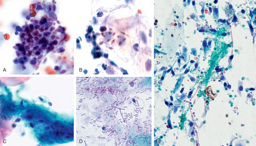 Figure 4.40, Bronchoalveolar lavage. A, Cluster of Candida yeast forms. Cervical Papanicolaou (Pap) smear. B, Candida yeast forms with budding. Cervical liquid-based Pap test (C) Cluster of ovoid spermatozoa heads admixed with seminal vesicle material. Cervical Pap smear (D) Spermatozoa admixed with large bacilli consistent with lactobacilli. Postmortem scrape preparation of Candida albicans pseudomembranous proctitis (E) . Colonic columnar epithelial cells and fungal blastoconidia and pseudohyphae are seen admixed with fibrin (all Papanicolaou stain, ×400).