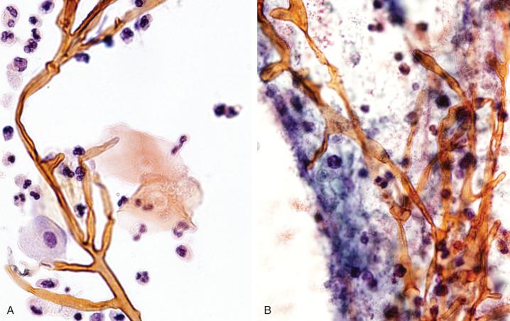 Figure 4.41, Urine (A) and kidney fine-needle aspirate (B) from a patient with renal and pulmonary zygomycosis. A, Large, ribbonlike hyphae are seen admixed with neutrophils. B, Necrosis, degenerating inflammatory cells, and broad hyphae are seen (Papanicolaou stain, ×400).