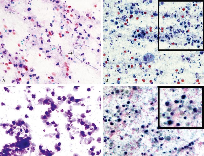 Figure 4.5, Fine-needle aspirations of a gram-negative bacterial abscess ( A and B ) and a large cell lymphoma ( C and D ). A, Neutrophil-rich exudate contains some bacilli (arrows) (Romanowsky stain, ×400). B, Neutrophils and macrophages are seen (Papanicolaou stain, ×400, inset ×1000). C, Smudgy cells, larger than the neutrophils seen in A , represent coagulative necrosis and apoptosis (Romanowsky stain, ×400). D, Coagulative necrosis, apoptosis, and degenerated blood (Papanicolaou stain, ×400, inset ×1000).