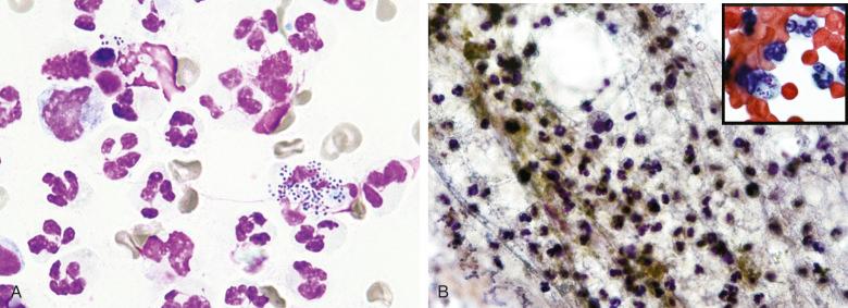 Figure 4.6, Fine-needle aspiration of neck mass. A, Exudate composed predominantly of neutrophils with a single macrophage containing blue-colored cocci that are readily distinguished from the more purple-colored cell nuclei (Romanowsky stain, ×1000). B, Fibrinopurulent exudate (Papanicolaou stain, ×400) and macrophage containing small, dark cocci, also shown in the inset (Papanicolaou stain, ×1000).
