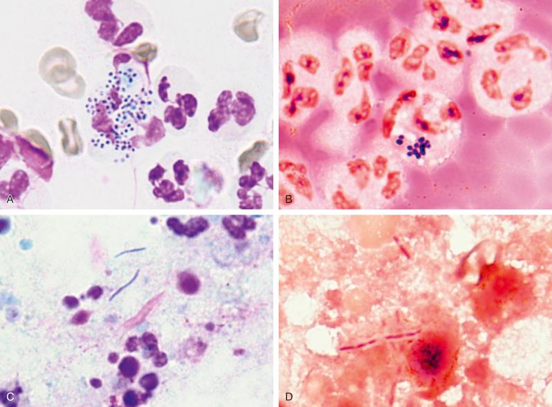 Figure 4.7, Fine-needle aspirations of two different cervical neck abscesses, with culture-proven Staphylococcus aureus ( A and B ) and Salmonella enteritidis ( C and D ). A, Large blue cocci within macrophage (Romanowsky stain). B, Cocci are gram-positive (Gram stain). C, Blue-colored bacilli admixed with degenerating inflammatory cells (Romanowsky stain). D, Gram-negative bacilli are seen (Gram stain). All magnifications are ×1500.