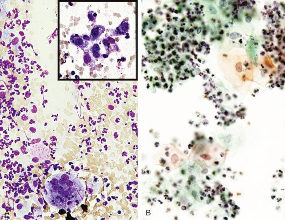 Figure 4.8, Fine-needle aspirations of two different neck masses: metastatic squamous cell carcinoma (A) and branchial cleft cyst (B) . A, Purulent exudate and presence of a giant cell; a cluster of atypical, poorly preserved cells is seen in the inset (both Romanowsky stain, ×400). B, Neutrophil-rich inflammatory exudate with presence of benign-appearing squamous cells (Papanicolaou stain, ×400).