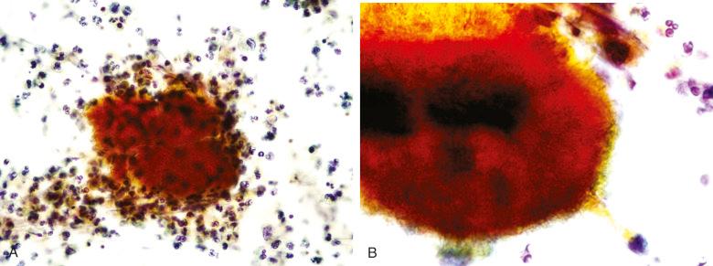 Figure 4.9, Fine-needle aspiration of cervical actinomycosis. A, A granule is seen surrounded by neutrophils (Papanicolaou stain, ×200). B, At higher magnification, hairlike filaments and a yellow-colored band are seen at the periphery of the granule (Papanicolaou stain, ×400).