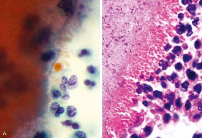 Figure 4.10, High-power images of fine-needle aspiration (FNA) and histologic section of actinomycosis with Splendore-Hoeppli phenomenon. A, FNA of neck mass shows club-shaped structures at the interface between the granule and the neutrophilic exudate (Papanicolaou stain, ×1000). B, Autopsy section from fatal pulmonary actinomycosis demonstrates a bright eosinophilic band and clubs at the microbe-exudate interface (hematoxylin and eosin stain, ×1000).