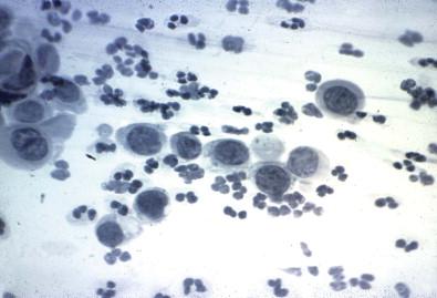 Figure 33-1, Carbowax not removed prior to staining. Note lack of chromatin detail and hazy appearance in a cell sample from a patient with a high-grade squamous intraepithelial lesion (Papanicolaou, ×HP).