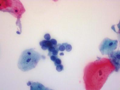 Figure 33-3, A ThinPrep sample in a patient with a high-grade squamous intraepithelial lesion (Papanicolaou, ×HP).