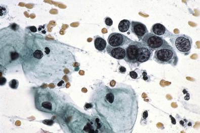 Figure 33-4, A conventional Papanicolaou smear from a patient with a high-grade squamous intraepithelial lesion. The cell sample was stained with the progressive method of the University of Chicago ( Table 31-2 ) (×HP).