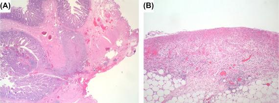 Figure 29.1, Perforated bowel after endoscopic balloon dilation. (A) A transmural tear; (B) serositis from the perforation.